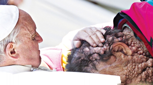 Dirljivo: Papa Franja blagoslovi čoveka  obolelog od  neurofibromatoze