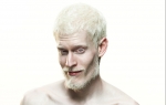 Albino muškarac