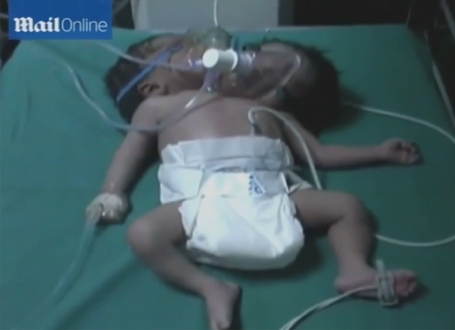 Beba sa dve glave / Printskrin:YouTube/ USWorldNews