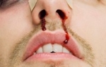Krvav nos Polomljen nos
