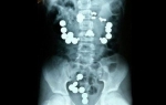 Hirurzi su iz stomaka deteta izvadili 42 magneta