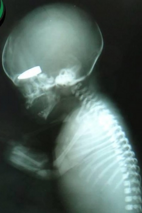 Užas: Rendgenski snimak ubijenog fetusa