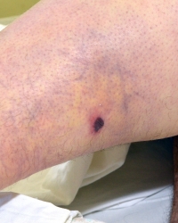 Rana od ugriza šarke na nozi Gruje Milojevića