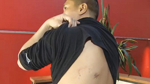 Bili Meknili  pokazuje  ožiljak od tuče  iz aprila 2010.