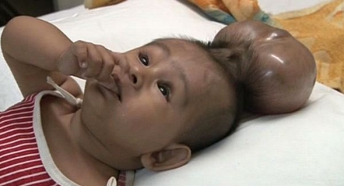 Jezivo: Parazitski blizanac bebi rastao na glavi