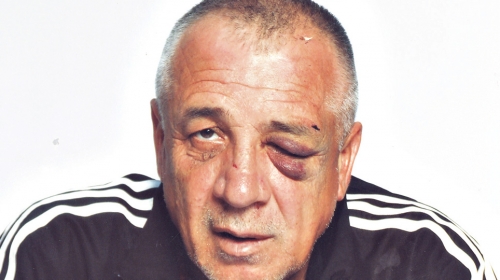 Otac Zoran zadobio je  prelom vilice na dva mesta i frakturu nosa
